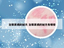 治银屑病的秘方 治银屑病的秘方有哪些
