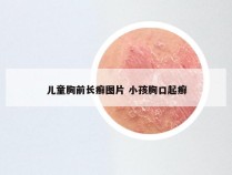 儿童胸前长癣图片 小孩胸口起癣
