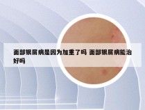 面部银屑病是因为加重了吗 面部银屑病能治好吗