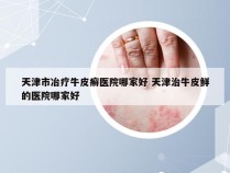 天津市冶疗牛皮癣医院哪家好 天津治牛皮鲜的医院哪家好
