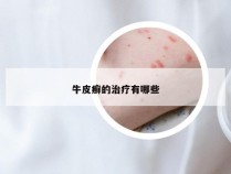 牛皮癣的治疗有哪些