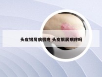 头皮银屑病很疼 头皮银屑病疼吗