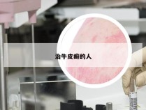 治牛皮癣的人