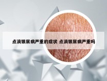 点滴银屑病严重的症状 点滴银屑病严重吗