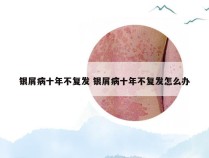 银屑病十年不复发 银屑病十年不复发怎么办