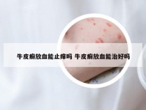 牛皮癣放血能止痒吗 牛皮癣放血能治好吗
