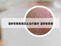 湿疹性银屑病怎么治疗最好 湿疹银霄病