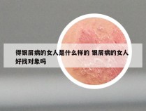 得银屑病的女人是什么样的 银屑病的女人 好找对象吗