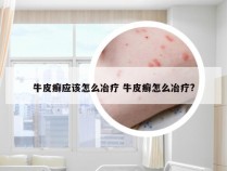 牛皮癣应该怎么冶疗 牛皮癣怎么冶疗?