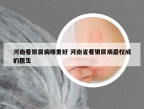 河南看银屑病哪里好 河南省看银屑病最权威的医生