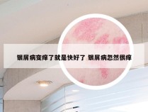 银屑病变痒了就是快好了 银屑病忽然很痒