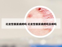 红皮性银屑病疼吗 红皮性银屑病疼吗会痒吗