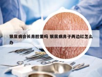 银屑病会长鼻腔里吗 银屑病鼻子两边红怎么办