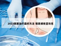 2023银屑治疗最好方法 银屑病有望攻克