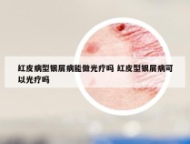 红皮病型银屑病能做光疗吗 红皮型银屑病可以光疗吗