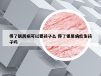 得了银屑病可以要孩子么 得了银屑病能生孩子吗