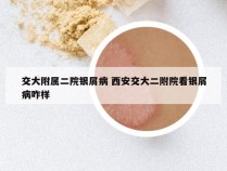 交大附属二院银屑病 西安交大二附院看银屑病咋样