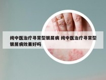 纯中医治疗寻常型银屑病 纯中医治疗寻常型银屑病效果好吗