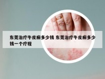 东莞治疗牛皮癣多少钱 东莞治疗牛皮癣多少钱一个疗程