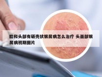 脸和头部有砺壳状银屑病怎么治疗 头面部银屑病初期图片