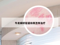牛皮癣好后留白斑怎样治疗