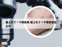 腿上长了一个银屑病 腿上长了一个银屑病怎么办