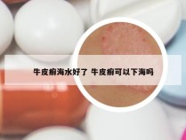 牛皮癣海水好了 牛皮癣可以下海吗