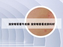 淮安哪家看牛皮癣 淮安哪里看皮肤科好