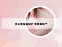 夏天牛皮癣裂口 牛皮癣裂了