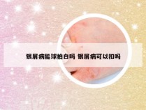 银屑病能球拍白吗 银屑病可以扣吗