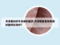 天津看的好牛皮癣的医院 天津哪里看银屑病的医院比较好?
