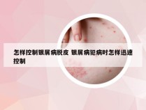 怎样控制银屑病脱皮 银屑病犯病时怎样迅速控制