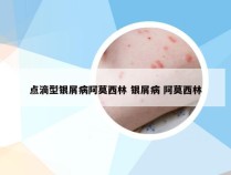 点滴型银屑病阿莫西林 银屑病 阿莫西林