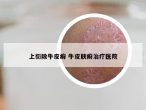 上街除牛皮癣 牛皮肤癣治疗医院
