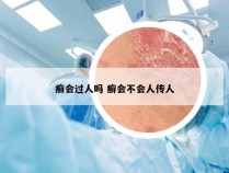 癣会过人吗 癣会不会人传人