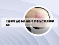 长春哪家治疗牛皮癣最好 长春治疗银屑病哪家好