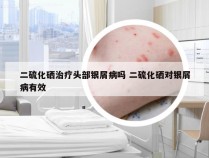 二硫化硒治疗头部银屑病吗 二硫化硒对银屑病有效