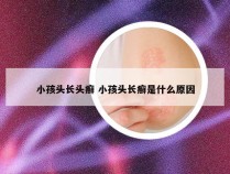 小孩头长头癣 小孩头长癣是什么原因