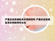 严重的皮肤病能用生物制剂吗 严重的皮肤病能用生物制剂吗女性