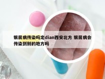 银屑病传染吗定dian西安北方 银屑病会传染到别的地方吗
