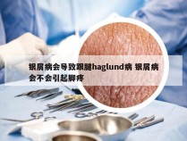 银屑病会导致跟腱haglund病 银屑病会不会引起脚疼