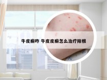 牛皮癣咋 牛皮皮癣怎么治疗除根