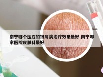 南宁哪个医院的银屑病治疗效果最好 南宁哪家医院皮肤科最好