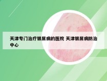 天津专门治疗银屑病的医院 天津银屑病防治中心