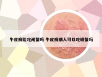 牛皮癣能吃闸蟹吗 牛皮癣病人可以吃螃蟹吗