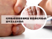 吃阿维a胶囊银屑病喝酒 银屑病吃阿维a的途中怎么还长新的