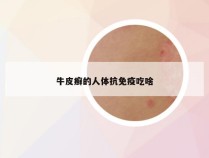牛皮癣的人体抗免疫吃啥
