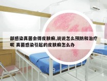 部感染真菌会得皮肤癣,说说怎么预防和治疗呢 真菌感染引起的皮肤癣怎么办