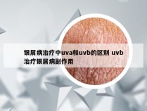 银屑病治疗中uva和uvb的区别 uvb治疗银屑病副作用
