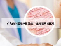 广东纯中医治疗银屑病 广东治银屑病医院
